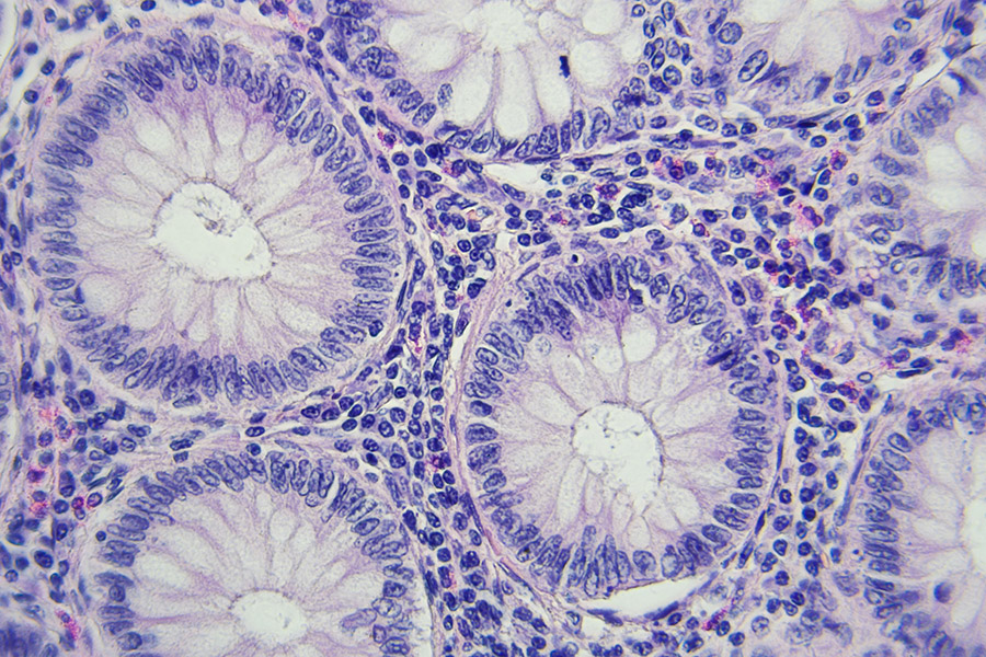 image_of_colon_cancer_cells